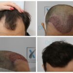 Costul unui implant de păr la clinica Dr. Felix Hair Implant te poate surprinde