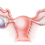 Chistectomie ovariană – Cum este și cum se tratează?