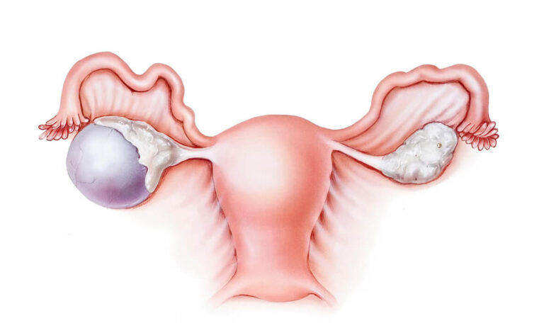 Chistectomie ovariană – Cum este și cum se tratează?