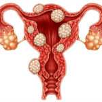 Ce este fibromul uterin? Cauze, simptome și tratament