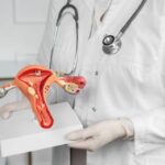 4 simptome care pot semnaliza prezența fibromului uterin