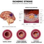 AVC ischemic: înțelegerea mecanismelor și impactul asupra creierului