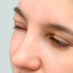 De ce se umflă ochii: 5 cauze comune