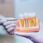 Dentist with tooth implant false teeth. Dentistry and healthcare