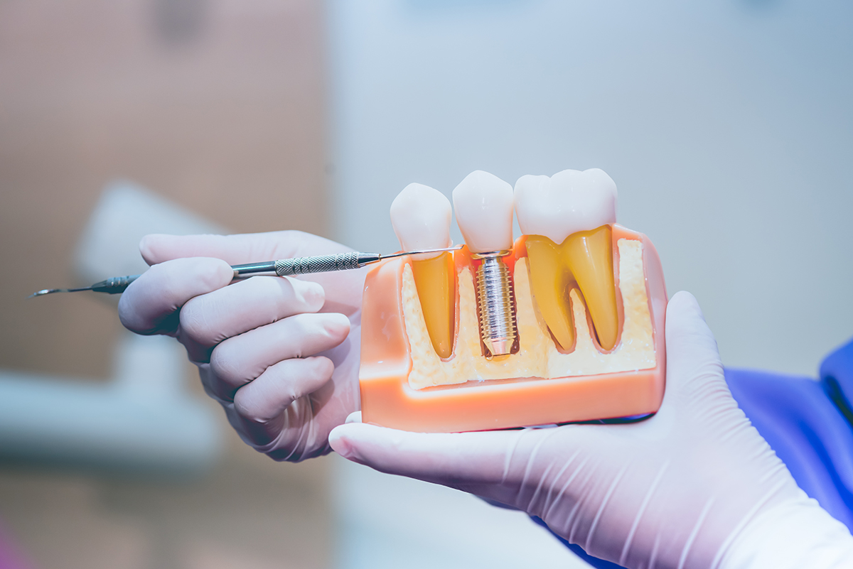 Câte implanturi dentare se pot insera într-o singură ședință?