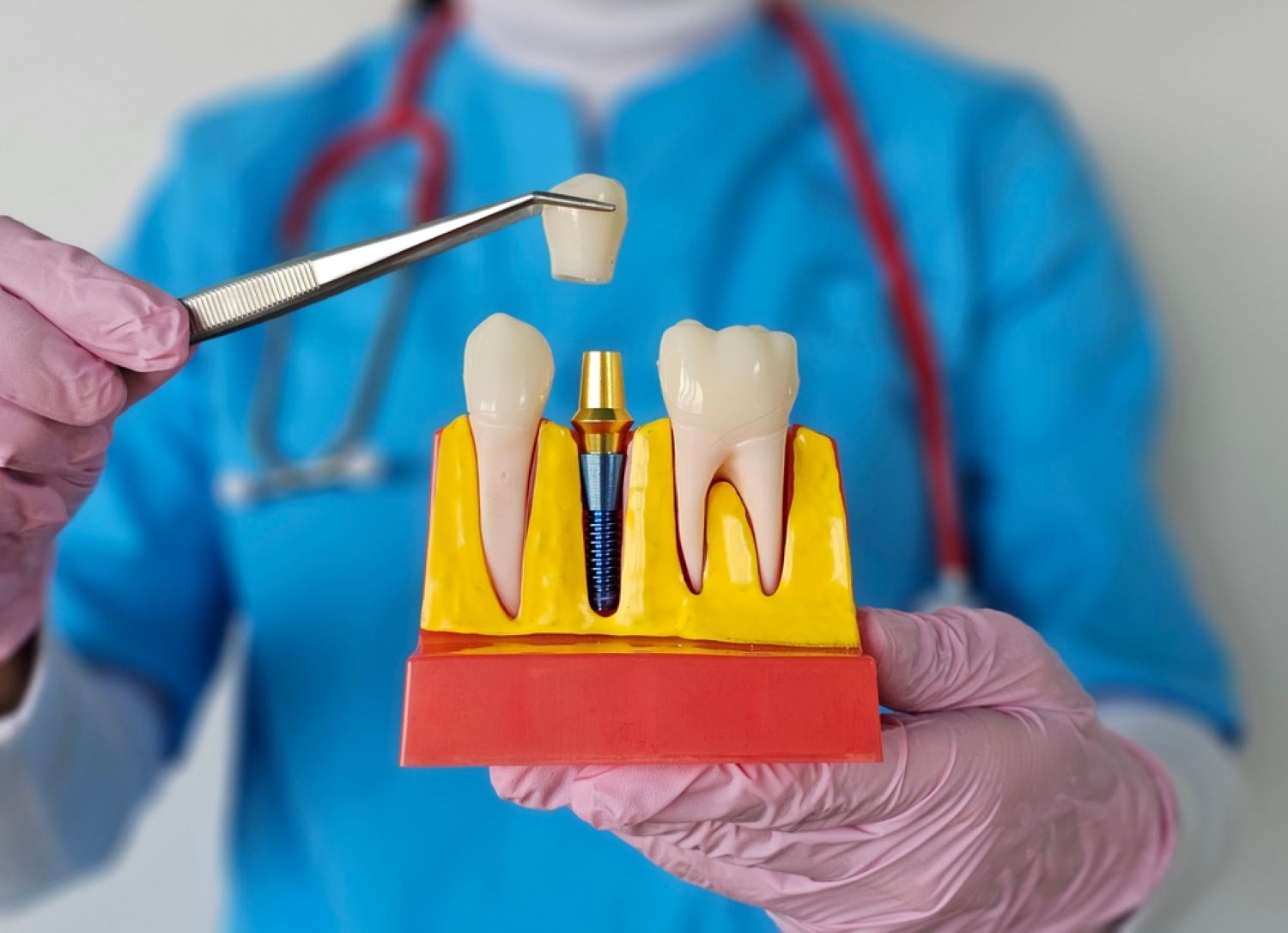 8 mituri și temeri legate de implanturile dentare  